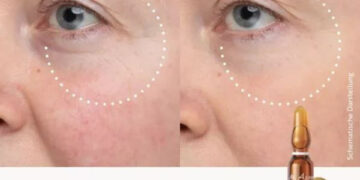 مزوتراپی رزوراترول مجیک برای جوانسازی