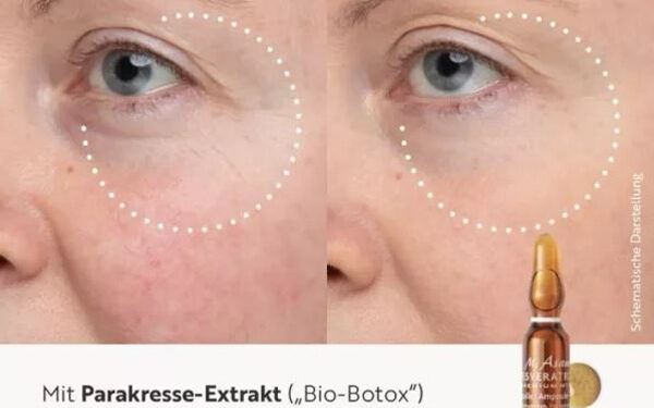 مزوتراپی رزوراترول مجیک برای جوانسازی