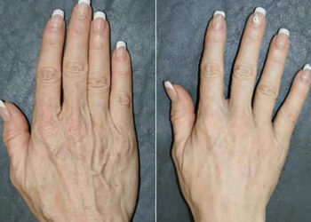 داروی خانگی برای چروک دست