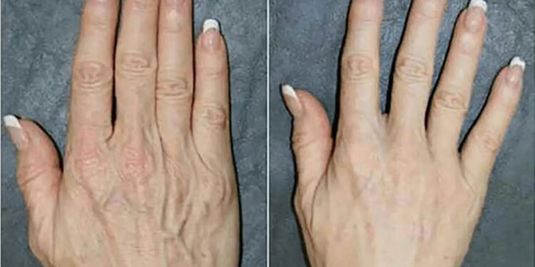 داروی خانگی برای چروک دست