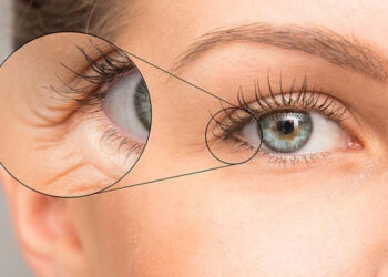 چروک زیر چشم موقع خندیدن