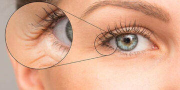 چروک زیر چشم موقع خندیدن