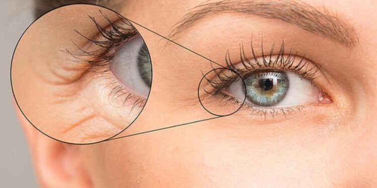 چروک زیر چشم موقع خندیدن