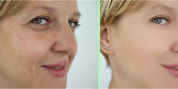 بادیان برای چروک صورت