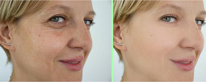 بادیان برای چروک صورت