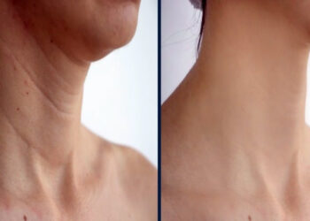 جوانسازی گردن با مزوژل