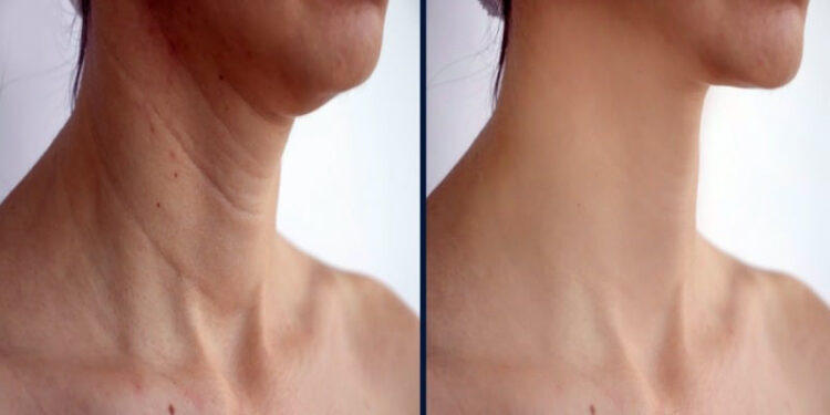 جوانسازی گردن با مزوژل