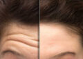 لیزر چروک پیشانی