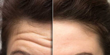 لیزر چروک پیشانی