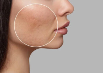 رفع منافذ باز پوست صورت