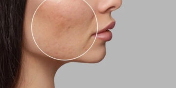 رفع منافذ باز پوست صورت