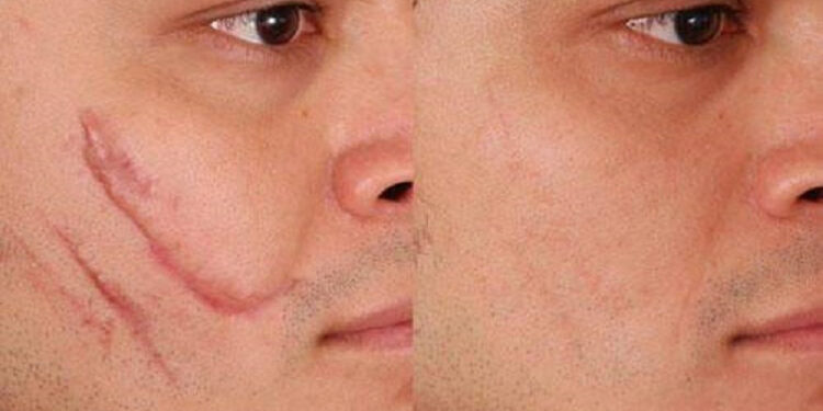 لیزر جای بخیه صورت