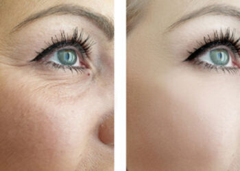 درمان چروک زیر چشم