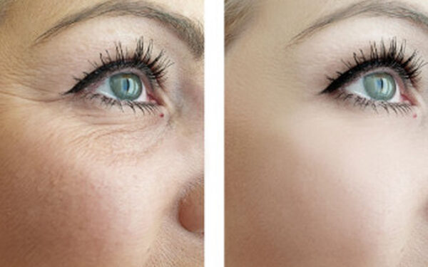 درمان چروک زیر چشم