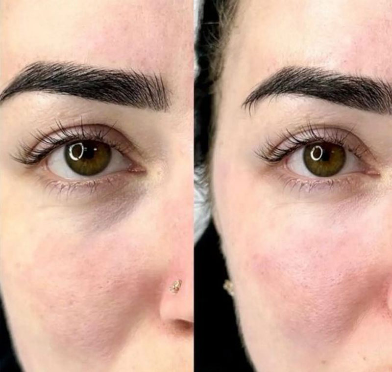 عوارض فیلر زیر چشم