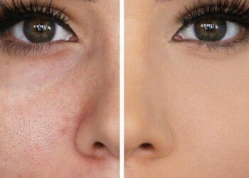 پوست پرتقالی صورت