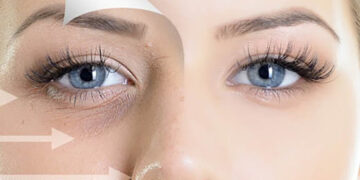 پی آر پی زیر چشم