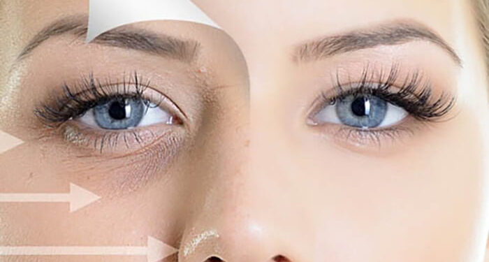 پی آر پی زیر چشم