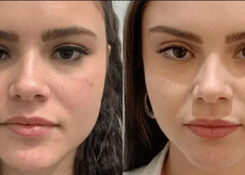 کشیدن پوست صورت با نخ