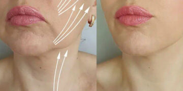 مینی لیفت صورت