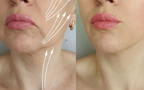 مینی لیفت صورت