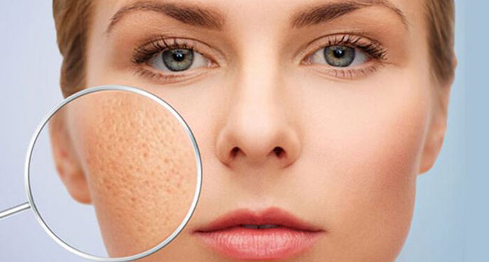 بستن منافذ باز پوست