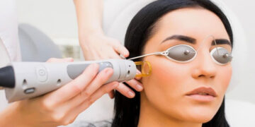 روشن كردن پوست صورت با ليزر