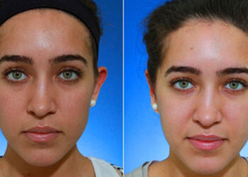 روشن کردن پوست صورت