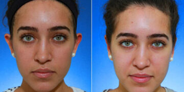 روشن کردن پوست صورت