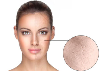 علت منافذ باز پوست