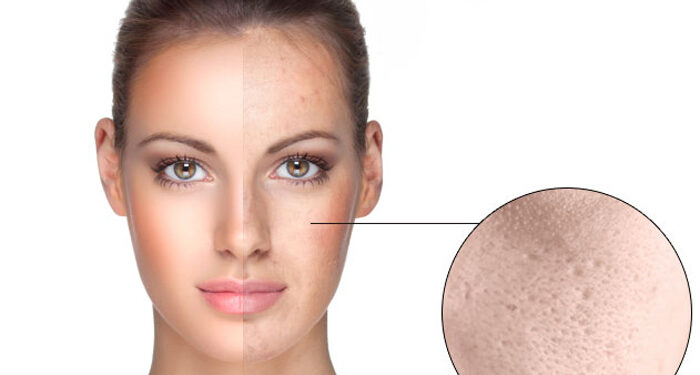 علت منافذ باز پوست