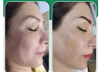 جوانساز پروسترولین