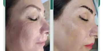 جوانساز پروسترولین