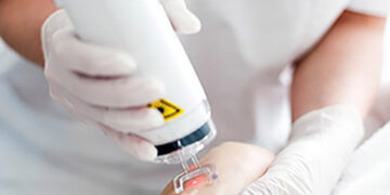 جوانسازی پوست دست با لیزر