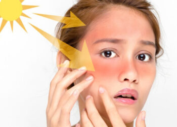 سفيد كردن پوست آفتاب سوخته