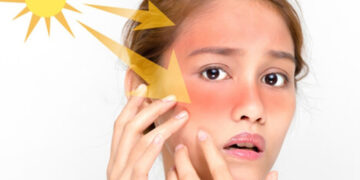 سفيد كردن پوست آفتاب سوخته