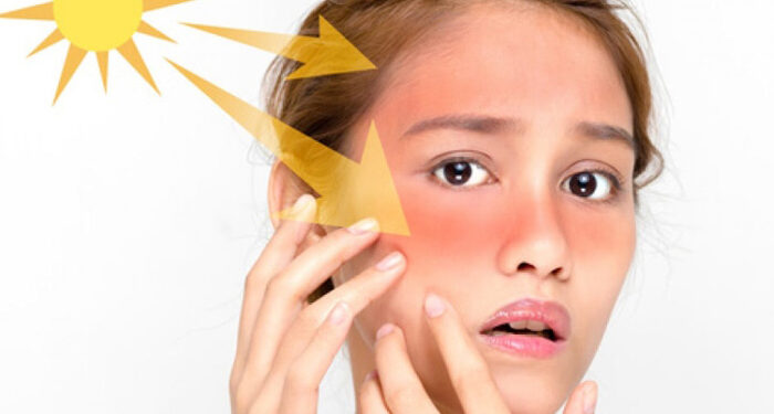 سفيد كردن پوست آفتاب سوخته