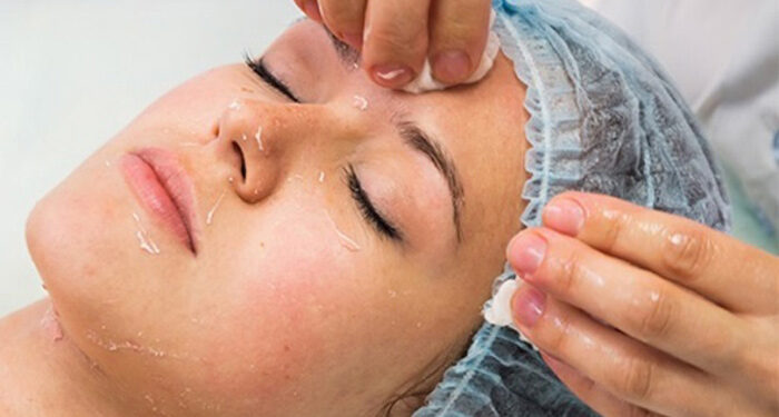 اسید تراپی پوست