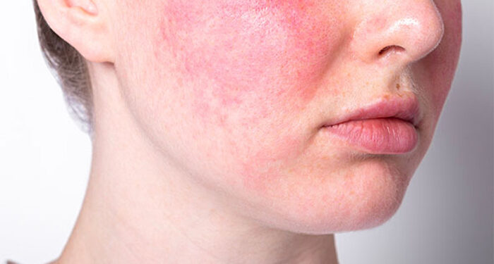 عوارض لایه برداری پوست صورت