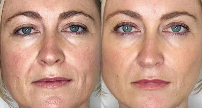 ماندگاری جراحی لیفت صورت