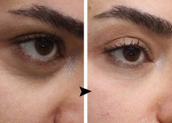 عوارض فیلر زیر چشم