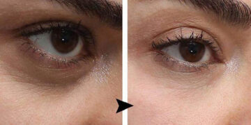 عوارض فیلر زیر چشم