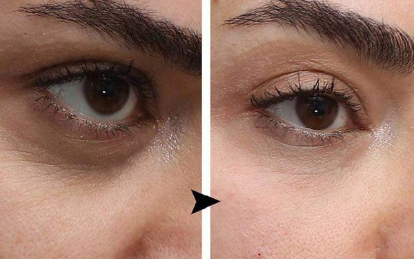 عوارض فیلر زیر چشم