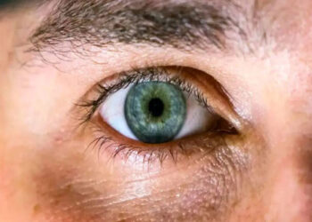 رفع گودی زیر چشم