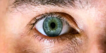 رفع گودی زیر چشم