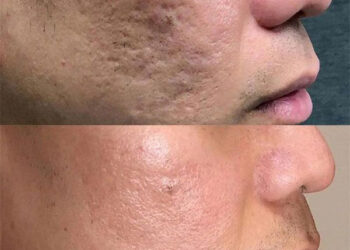 سابسیژن پوست