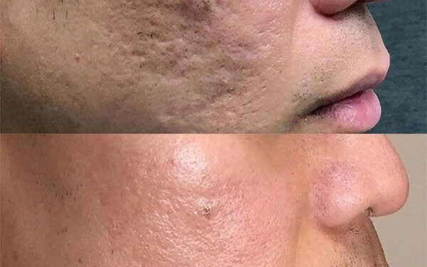 سابسیژن پوست