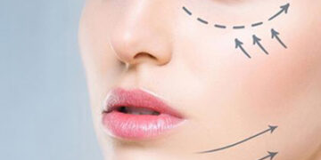 اندولیفت کل صورت