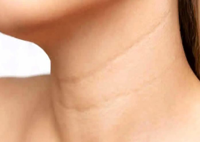 از بین بردن چروک گردن