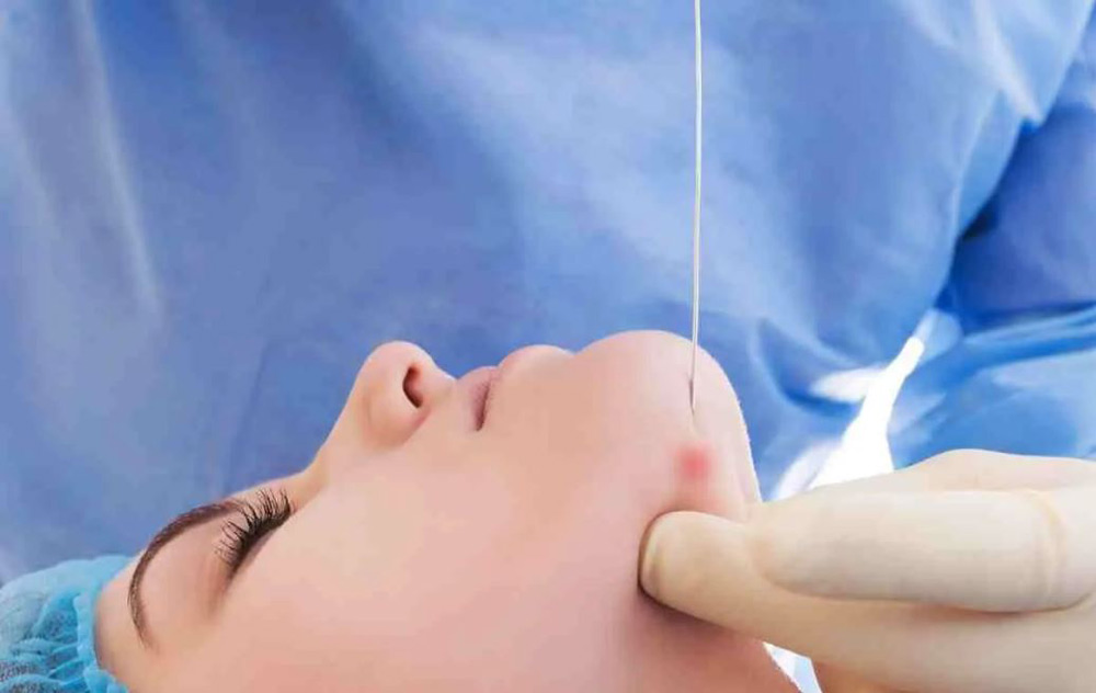 اندولیفت کل صورت